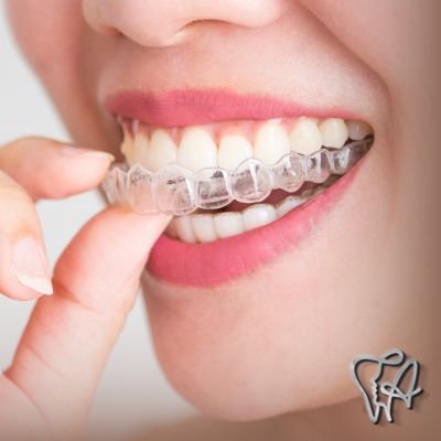 Alinhador Dental Transparente em Guarulhos SP