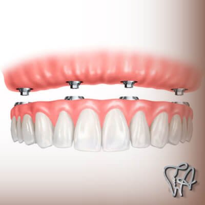 Colocação da prótese sobre implante dentário em Itapegica em Guarulhos