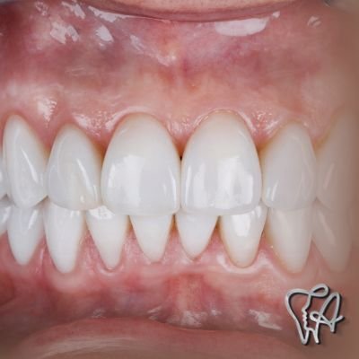 Dentes de porcelana no Inocoop Guarulhos