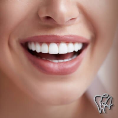 Faceta dental em Invernada em Guarulhos