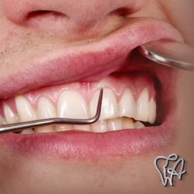 Gengivoplastia no Centro em Guarulhos