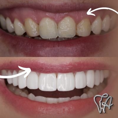 Gengivoplastia no Mikail em Guarulhos