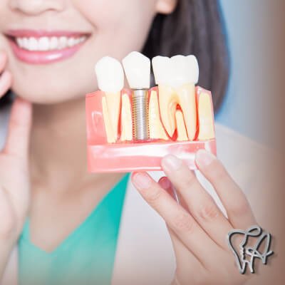 Implante dentário em Nova Bonsucesso - Guarulhos