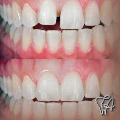 Lentes de contato dental em Orquidiama - Guarulhos