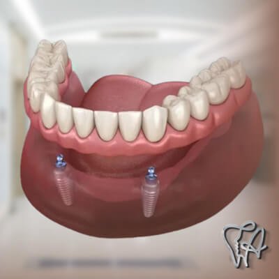 Prótese dentária sobre implantes em São Domingos - Guarulhos