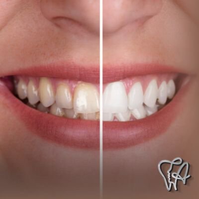 Resina no dente em Vila Nova Bonsucesso - Guarulhos