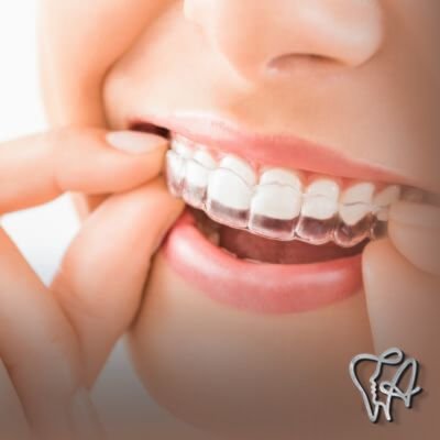 Tratamento ortodôntico com invisalign no CECAP em Guarulhos